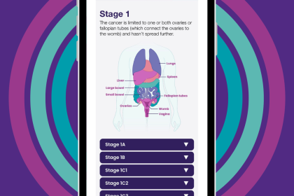 A mobile phone screen showing the new stages tool explaining ovarian cancer stages and grades