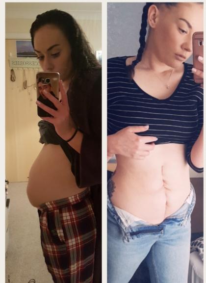 Sarah's bloated belly before treatment and scar after treatment