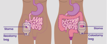 colostomy vs ileostomy 