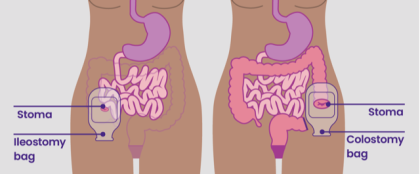 Urostomy Bag vs. Colostomy Bag: What's the Difference?